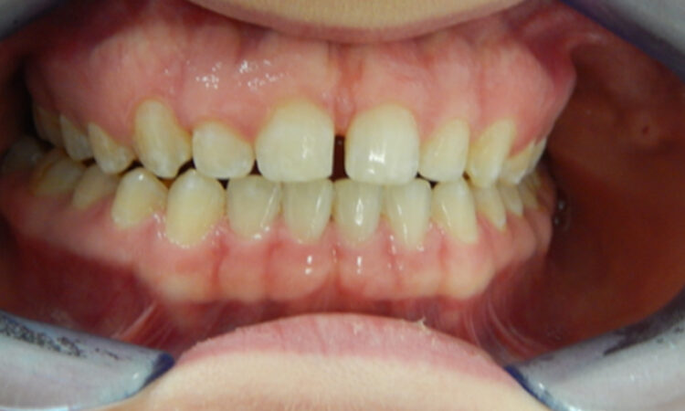 After - puredental
