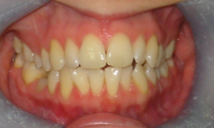 Before - puredental