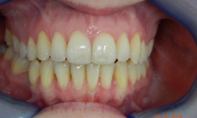 After - puredental