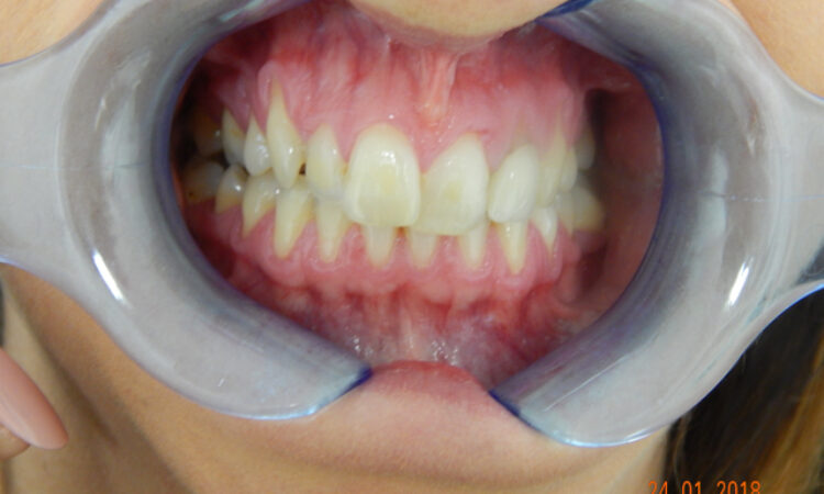 Before - puredental