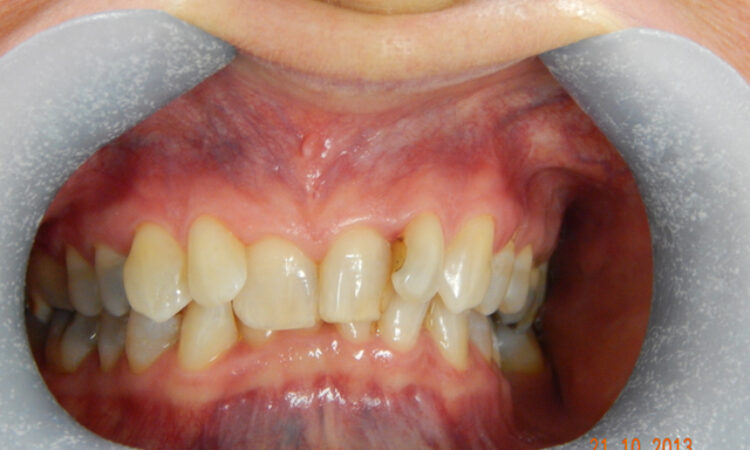Before - puredental