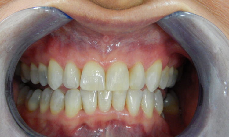 After - puredental
