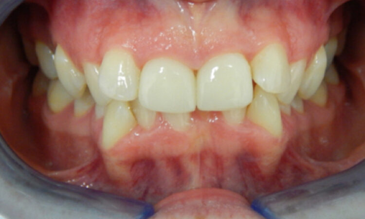 Before - puredental
