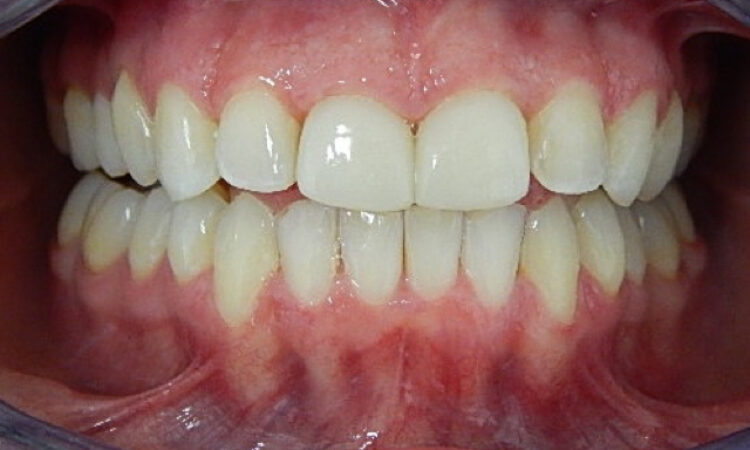 After - puredental