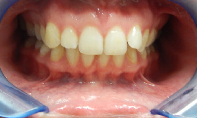 Before - puredental