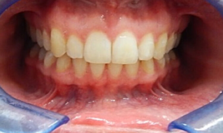 After - puredental