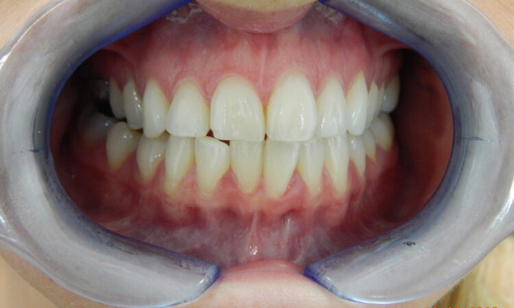 Before - puredental